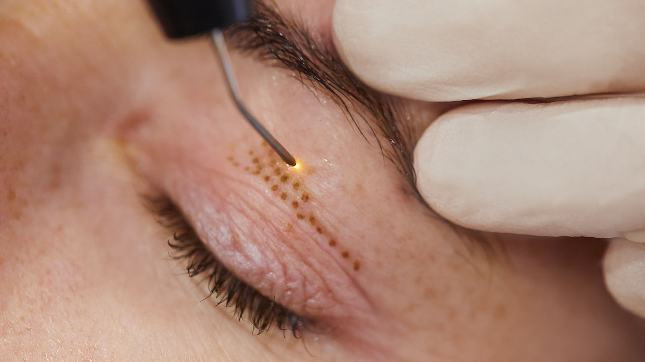 Plazma Pen ile Ameliyatsız Göz Çevresi Gençleştirme